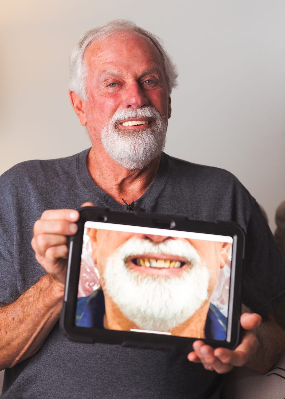 Before-and-after dental implants for a real Old Betsy Dental patient — his restored smile, Keene TX